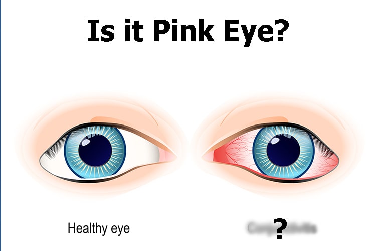 What is Commonly Misdiagnosed as Pink Eye? - Health Report