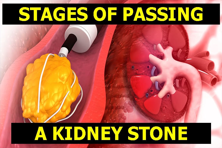 The 4 Stages of Passing a Kidney Stone & Recognizing Early Signs ...