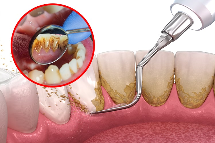 How To Remove Tartar From Your Teeth Without A Dentist Health Report