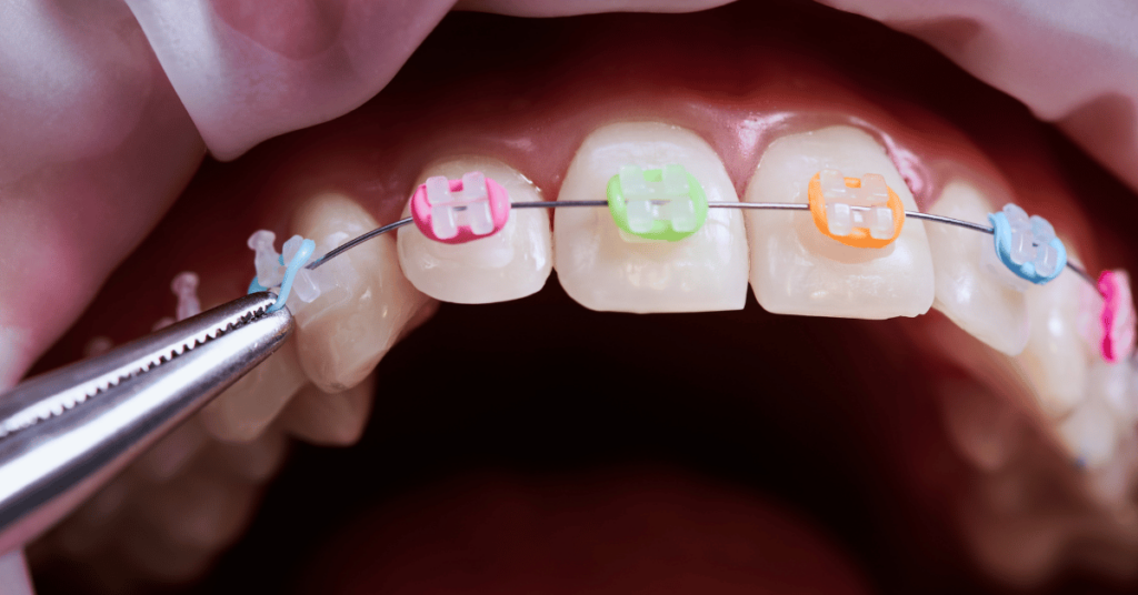 An orthodontist places rubber bands on braces