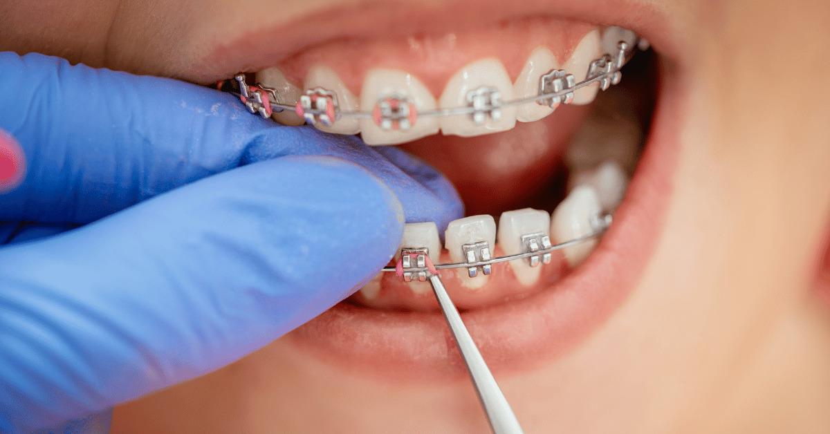An orthodontist applies rubber bands to braces
