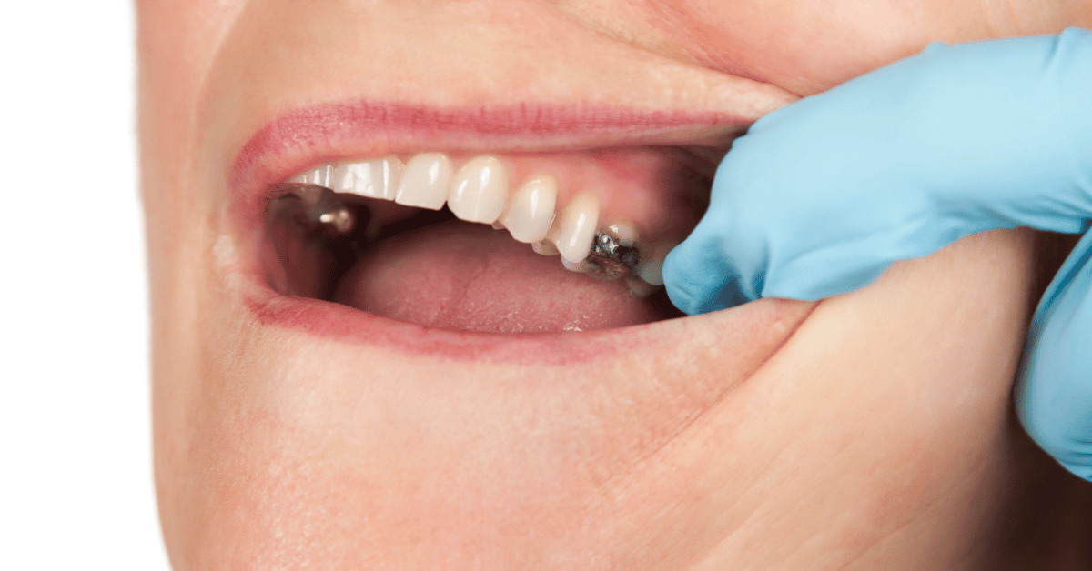 A patient has a half-broken molar tooth
