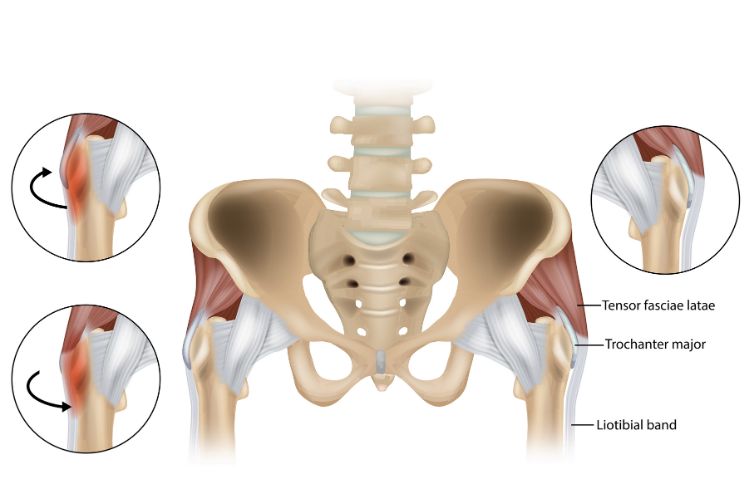 A conceptual image depicting lateral hip pain