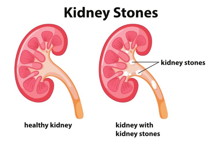 A graphic depiction of kidney stones